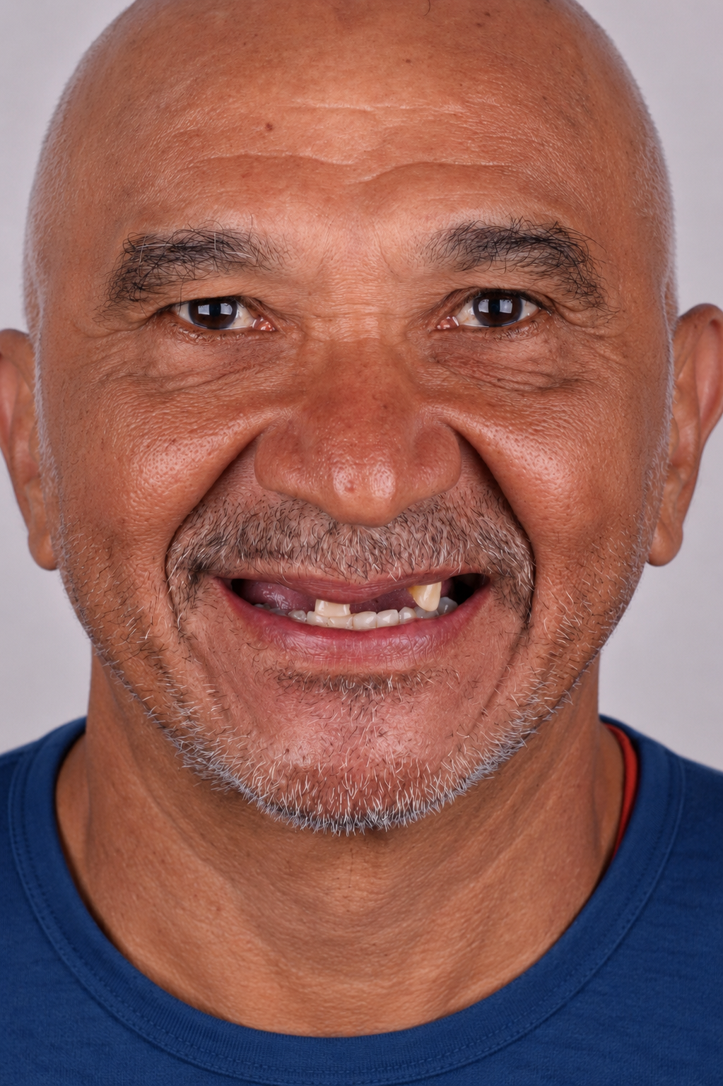 Antes da reabilitação total com implantes dentários — paciente real Costa Lima Recreio