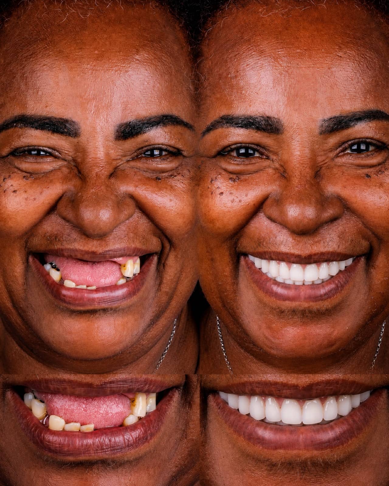 Antes e depois de reabilitação com prótese protocolo sobre implantes — paciente real da Costa Lima Odontologia, Recreio